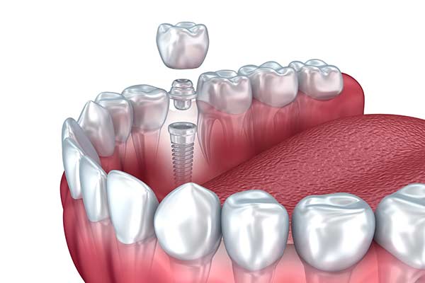 Tooth shade guide being held up to teeth